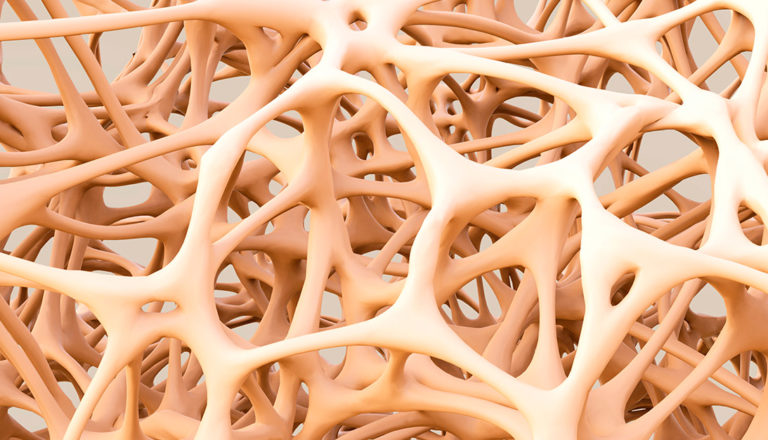 Malattie metaboliche - Osteoporosi